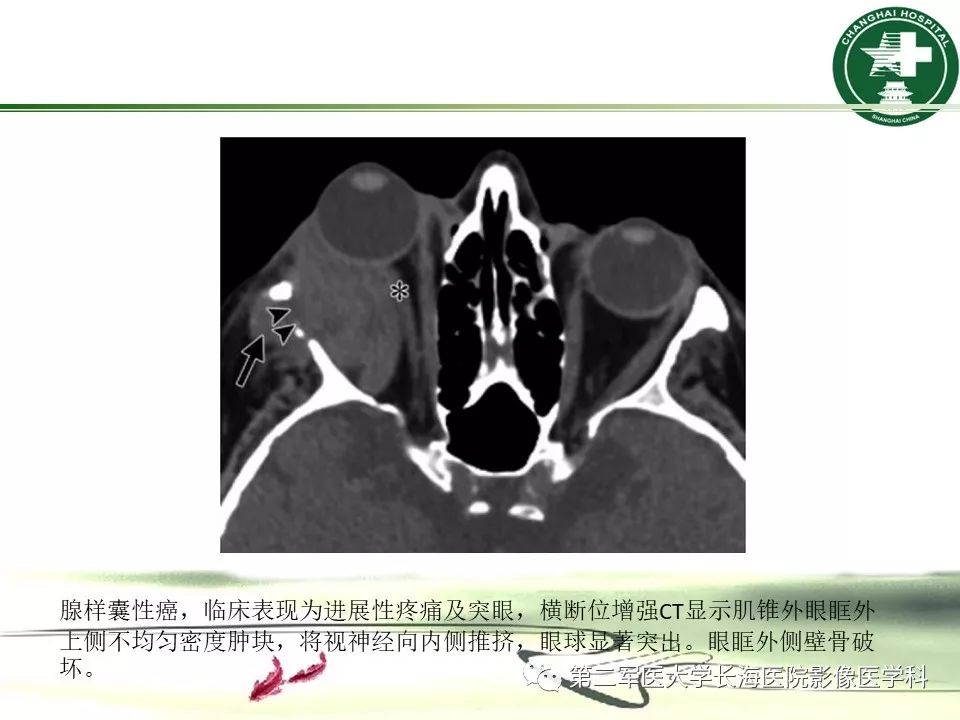 影像PPT - 【PPT】成人眼眶肿瘤：临床、影像、病理表现-31