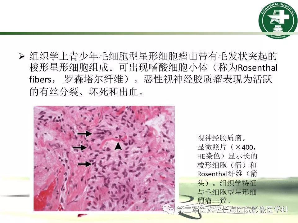 影像PPT - 【PPT】成人眼眶肿瘤：临床、影像、病理表现-33
