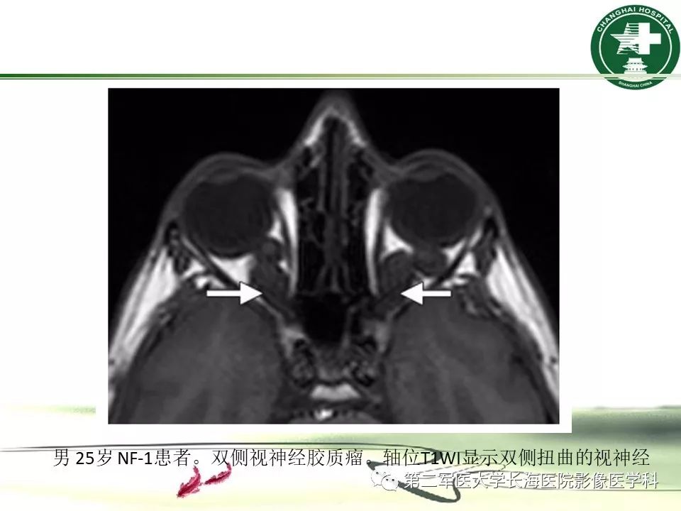 影像PPT - 【PPT】成人眼眶肿瘤：临床、影像、病理表现-37