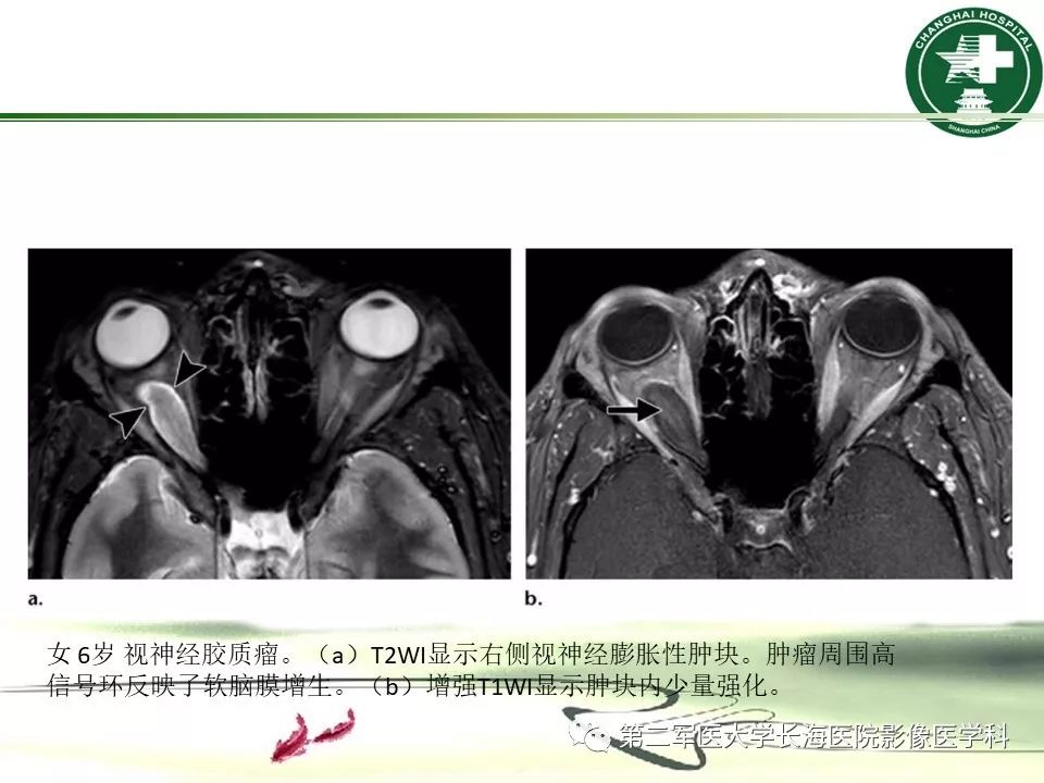 影像PPT - 【PPT】成人眼眶肿瘤：临床、影像、病理表现-35