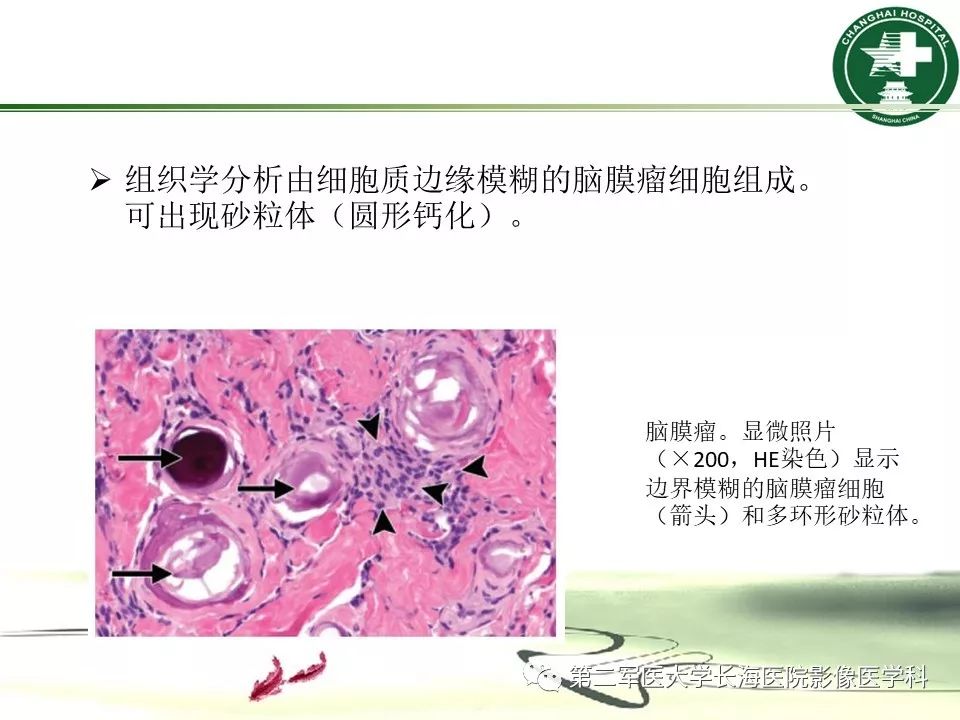 影像PPT - 【PPT】成人眼眶肿瘤：临床、影像、病理表现-39