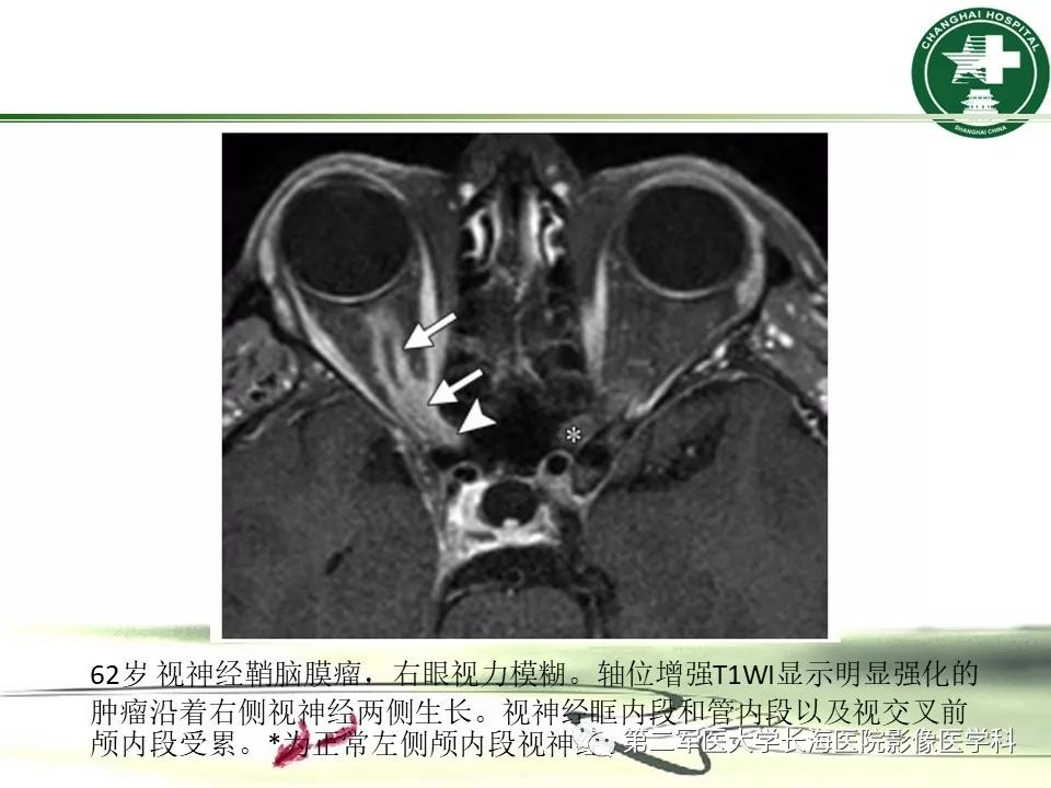 影像PPT - 【PPT】成人眼眶肿瘤：临床、影像、病理表现-42