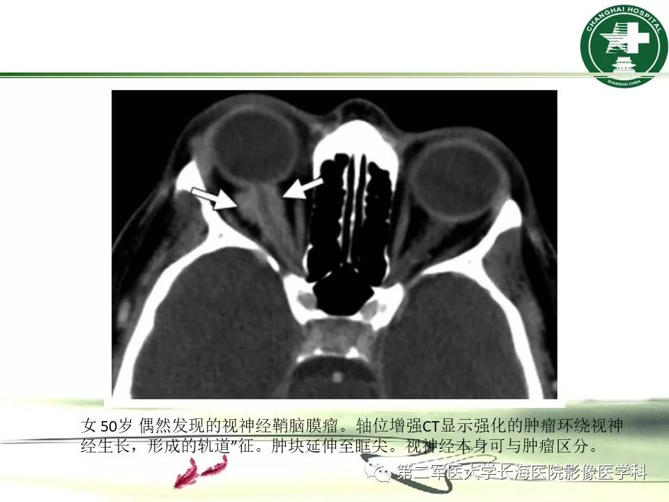影像PPT - 【PPT】成人眼眶肿瘤：临床、影像、病理表现-41