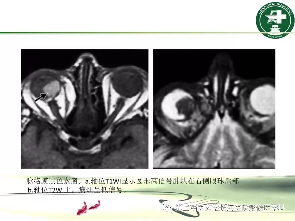 影像PPT - 【PPT】成人眼眶肿瘤：临床、影像、病理表现-49