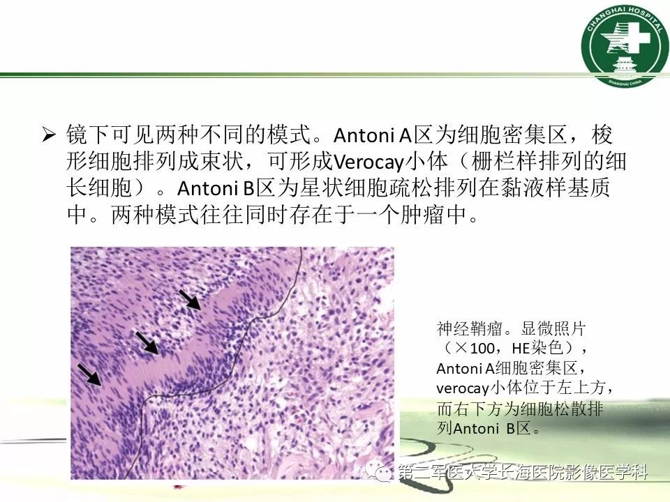 影像PPT - 【PPT】成人眼眶肿瘤：临床、影像、病理表现-44