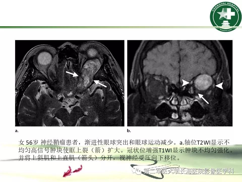 影像PPT - 【PPT】成人眼眶肿瘤：临床、影像、病理表现-46