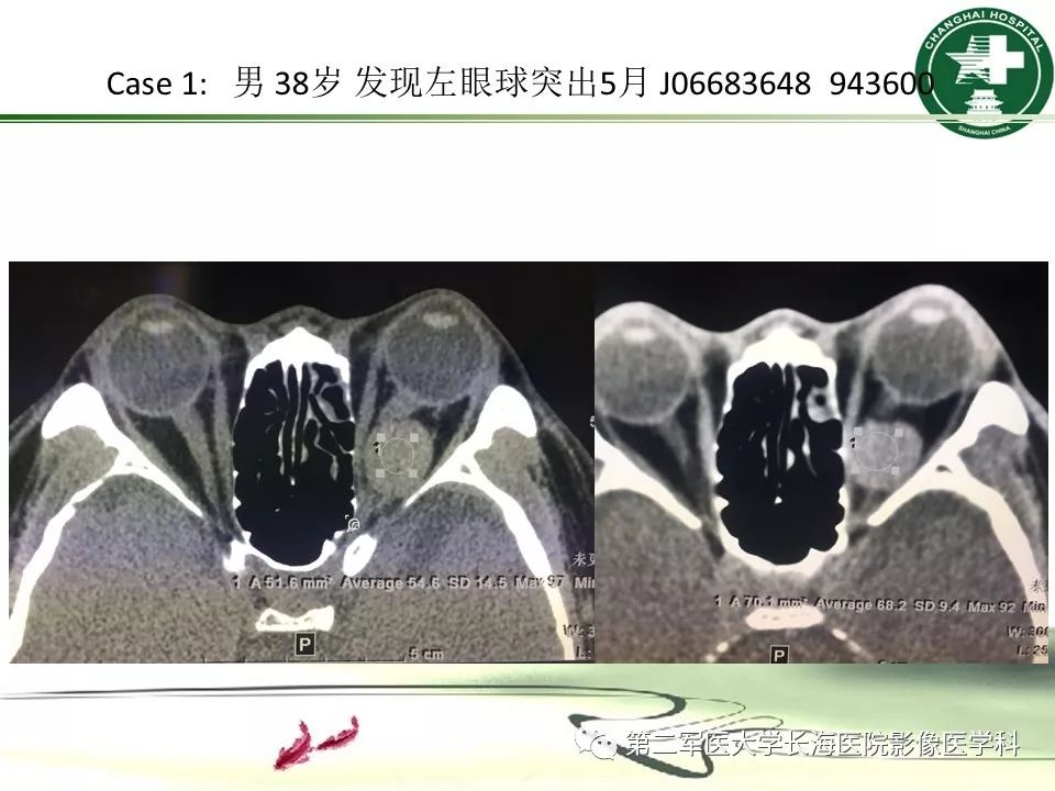 影像PPT - 【PPT】成人眼眶肿瘤：临床、影像、病理表现-53