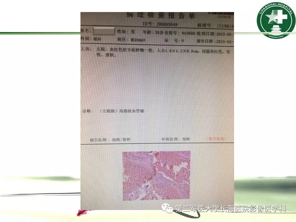 影像PPT - 【PPT】成人眼眶肿瘤：临床、影像、病理表现-54