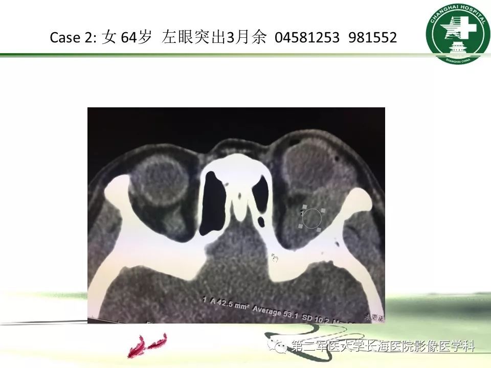 影像PPT - 【PPT】成人眼眶肿瘤：临床、影像、病理表现-55