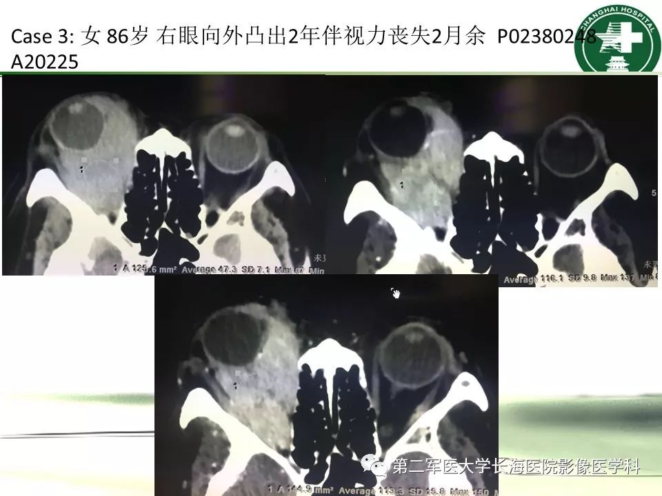 影像PPT - 【PPT】成人眼眶肿瘤：临床、影像、病理表现-58