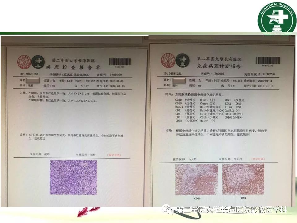 影像PPT - 【PPT】成人眼眶肿瘤：临床、影像、病理表现-57