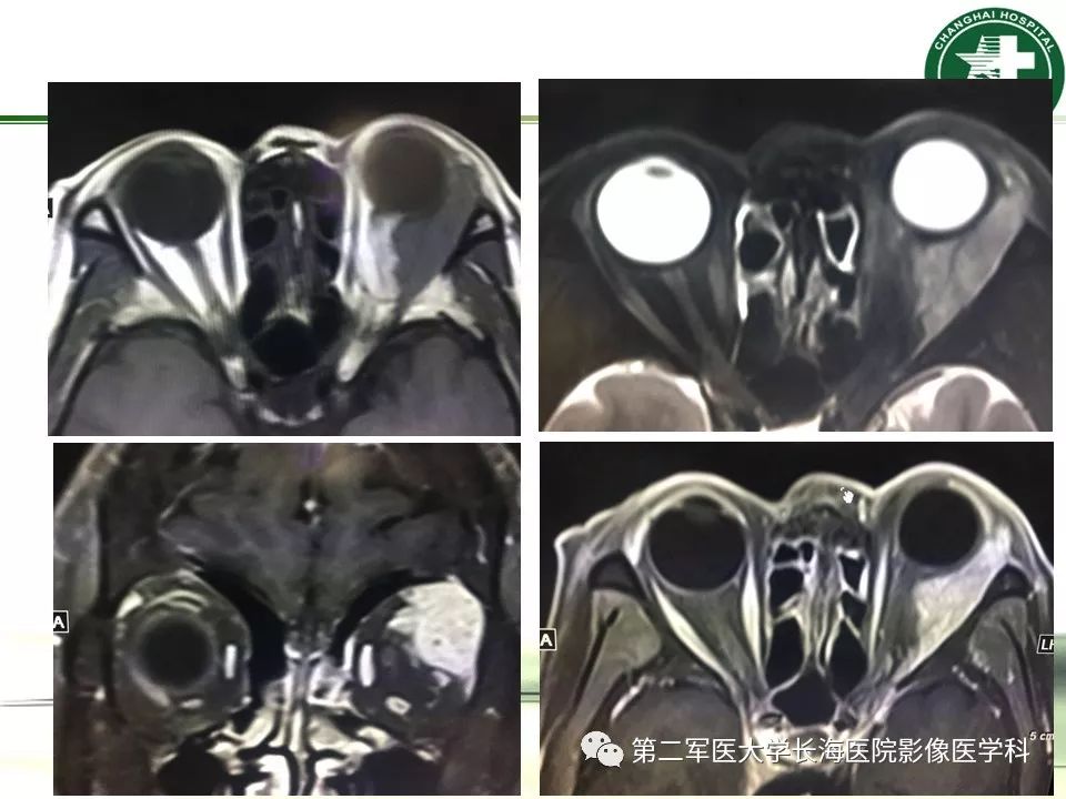 影像PPT - 【PPT】成人眼眶肿瘤：临床、影像、病理表现-56