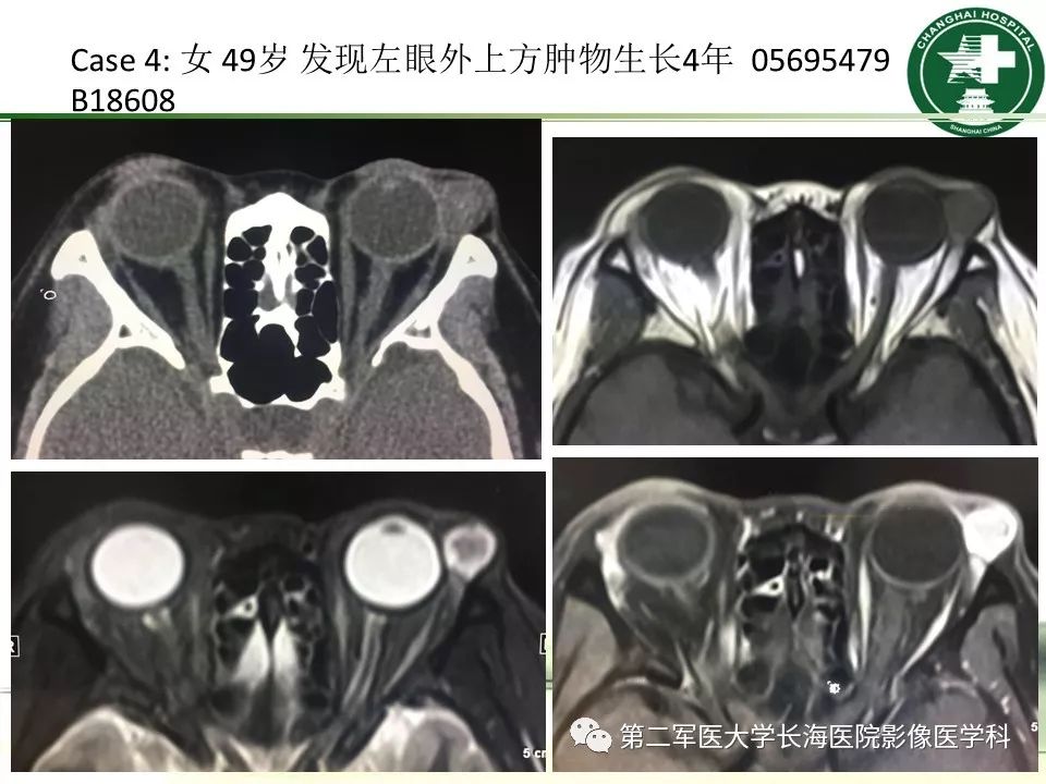 影像PPT - 【PPT】成人眼眶肿瘤：临床、影像、病理表现-60