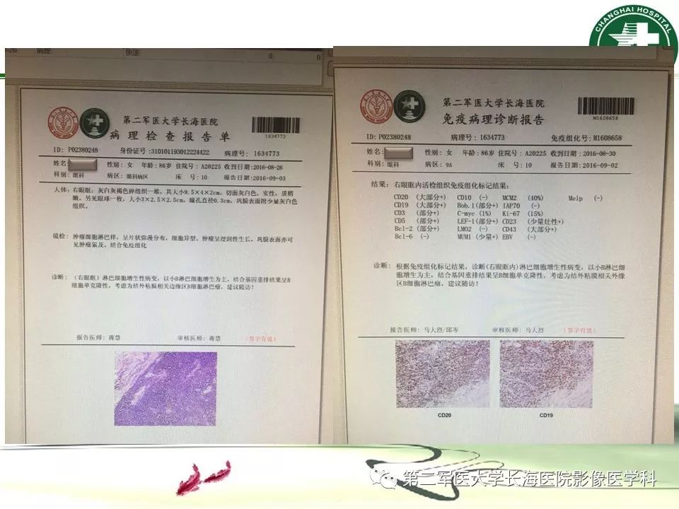 影像PPT - 【PPT】成人眼眶肿瘤：临床、影像、病理表现-59