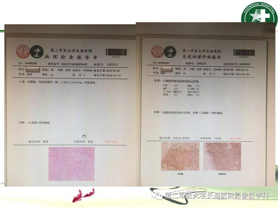 影像PPT - 【PPT】成人眼眶肿瘤：临床、影像、病理表现-65