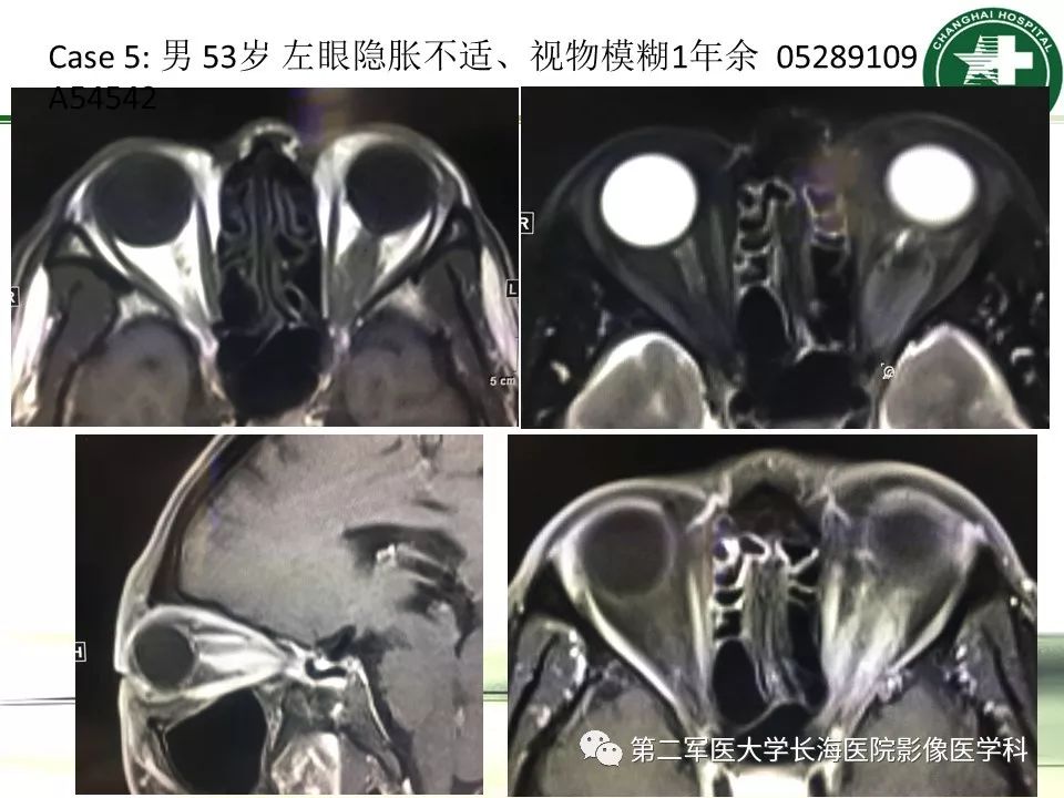 影像PPT - 【PPT】成人眼眶肿瘤：临床、影像、病理表现-62