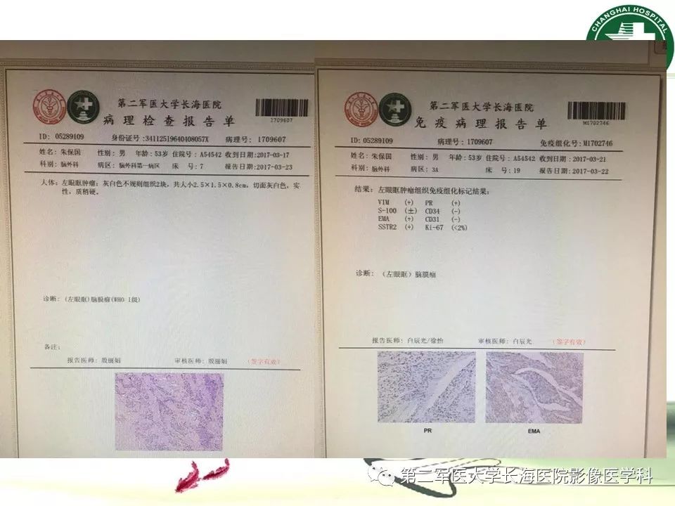 影像PPT - 【PPT】成人眼眶肿瘤：临床、影像、病理表现-63