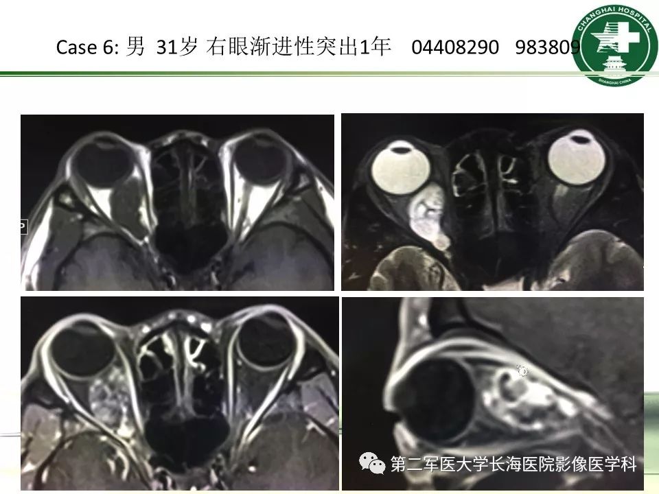 影像PPT - 【PPT】成人眼眶肿瘤：临床、影像、病理表现-64