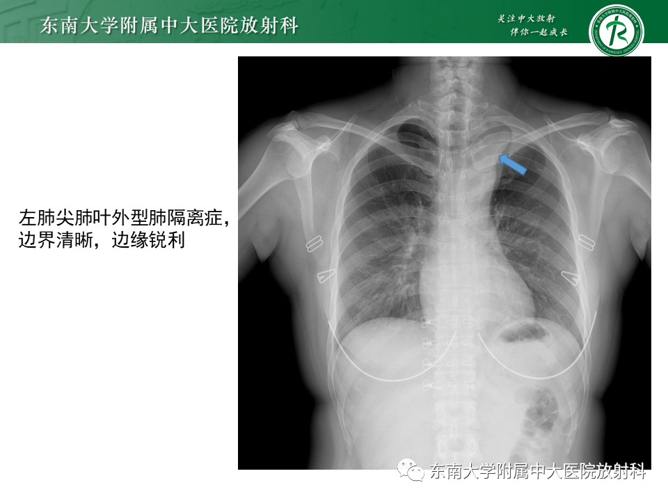 影像PPT - 【PPT】肺隔离症-12