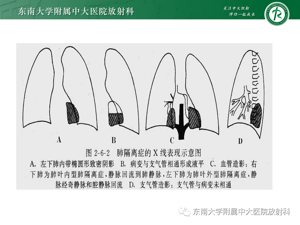 影像PPT - 【PPT】肺隔离症-11