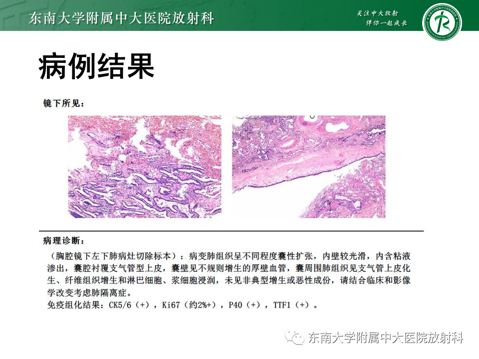 影像PPT - 【PPT】肺隔离症-2