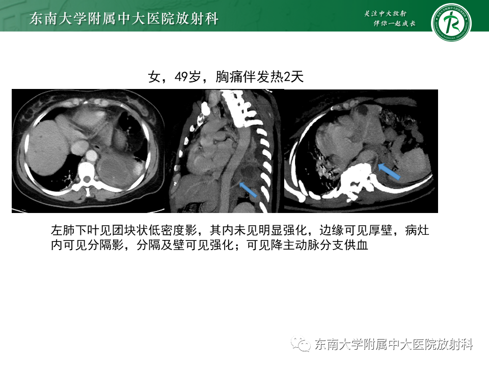影像PPT - 【PPT】肺隔离症-15