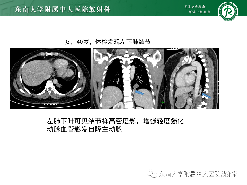 影像PPT - 【PPT】肺隔离症-14