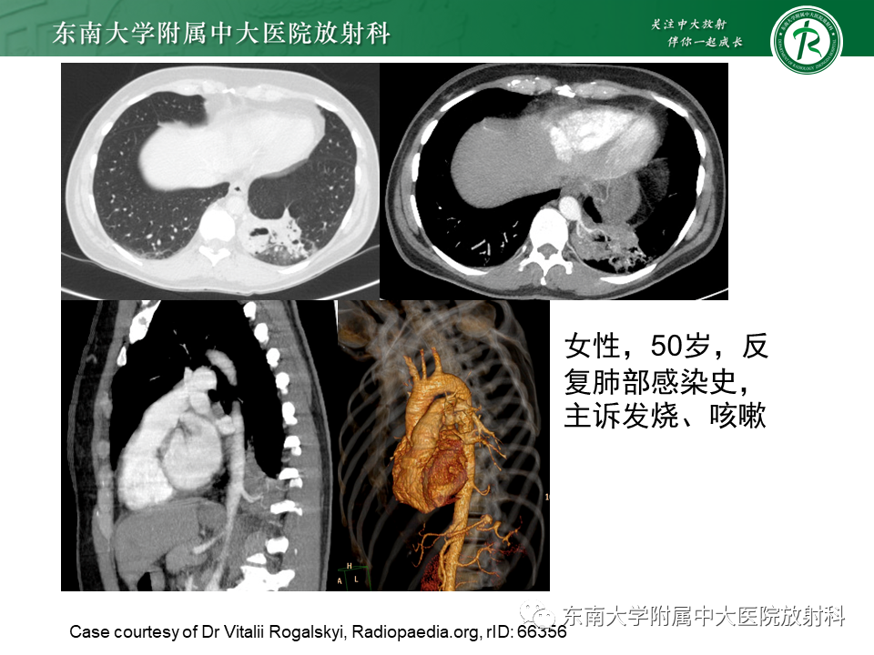 影像PPT - 【PPT】肺隔离症-16