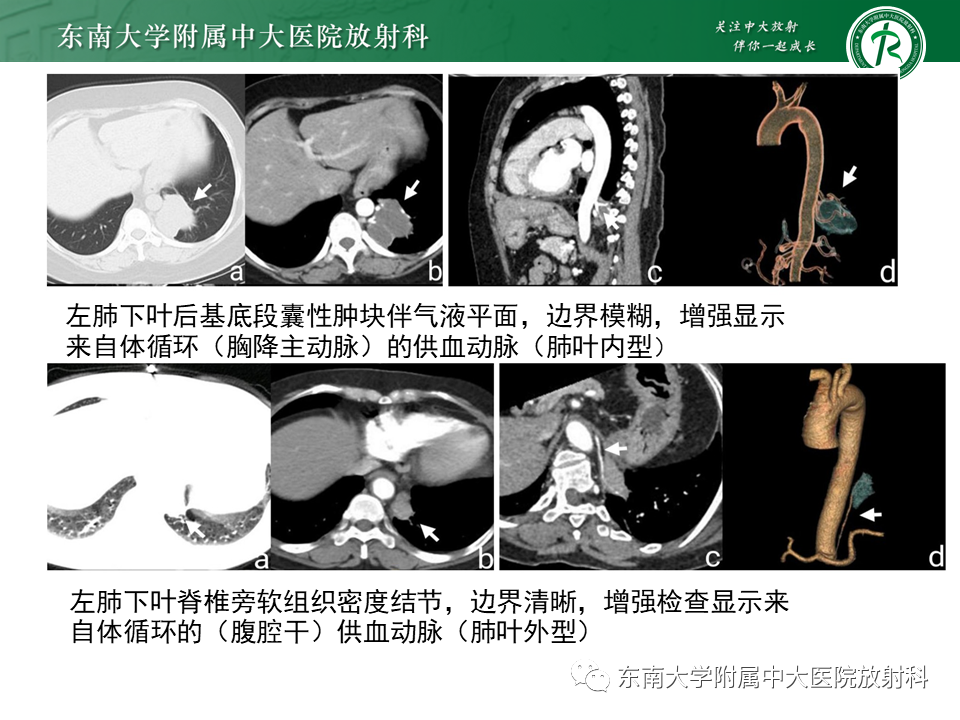 影像PPT - 【PPT】肺隔离症-17