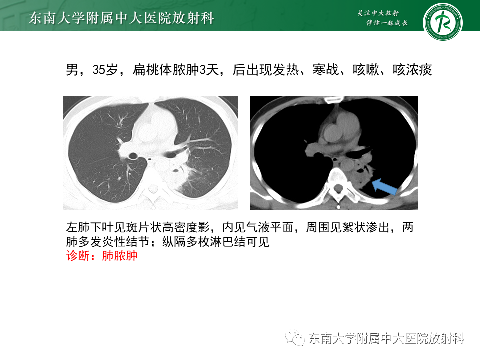 影像PPT - 【PPT】肺隔离症-19