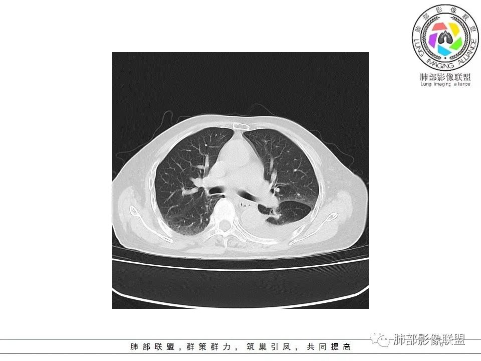 影像PPT - 【病例】最常见的纠结—老年女性,肺部大片实变影-6 影像PPT - 【病例】最常见的纠结—老年女性,肺部大片实变影-6