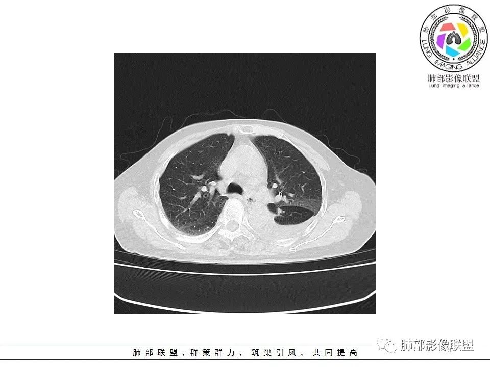 影像PPT - 【病例】最常见的纠结—老年女性,肺部大片实变影-3 影像PPT - 【病例】最常见的纠结—老年女性,肺部大片实变影-3