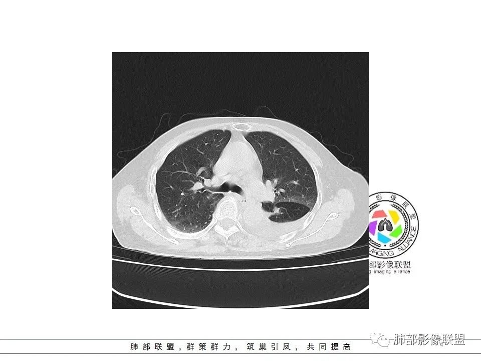 影像PPT - 【病例】最常见的纠结—老年女性,肺部大片实变影-4 影像PPT - 【病例】最常见的纠结—老年女性,肺部大片实变影-4