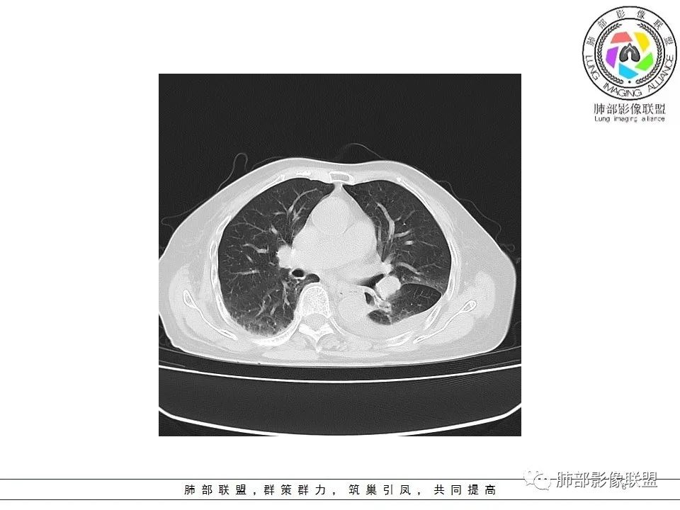 影像PPT - 【病例】最常见的纠结—老年女性,肺部大片实变影-8 影像PPT - 【病例】最常见的纠结—老年女性,肺部大片实变影-8