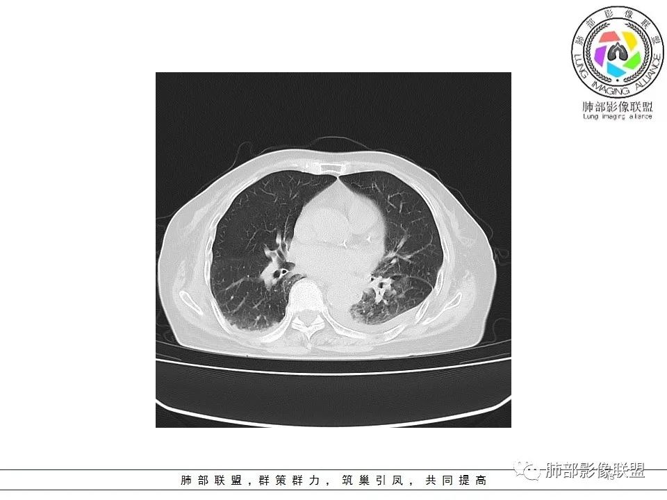 影像PPT - 【病例】最常见的纠结—老年女性,肺部大片实变影-13 影像PPT - 【病例】最常见的纠结—老年女性,肺部大片实变影-13