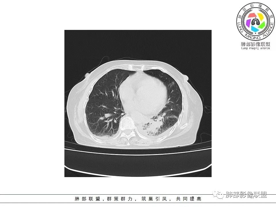 影像PPT - 【病例】最常见的纠结—老年女性,肺部大片实变影-17 影像PPT - 【病例】最常见的纠结—老年女性,肺部大片实变影-17