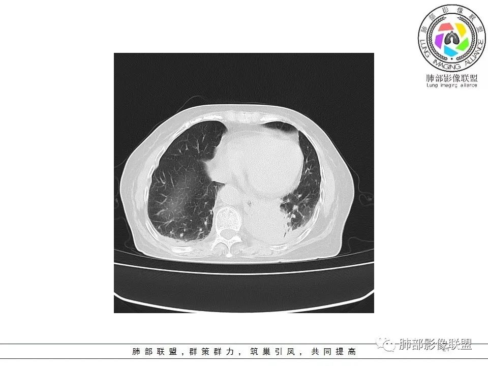 影像PPT - 【病例】最常见的纠结—老年女性,肺部大片实变影-21 影像PPT - 【病例】最常见的纠结—老年女性,肺部大片实变影-21