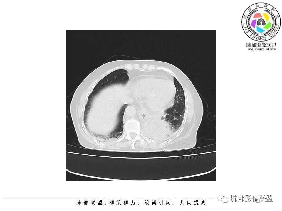影像PPT - 【病例】最常见的纠结—老年女性,肺部大片实变影-23 影像PPT - 【病例】最常见的纠结—老年女性,肺部大片实变影-23
