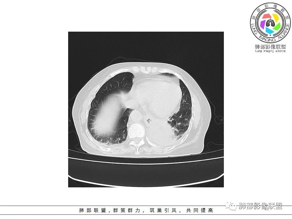 影像PPT - 【病例】最常见的纠结—老年女性,肺部大片实变影-22 影像PPT - 【病例】最常见的纠结—老年女性,肺部大片实变影-22