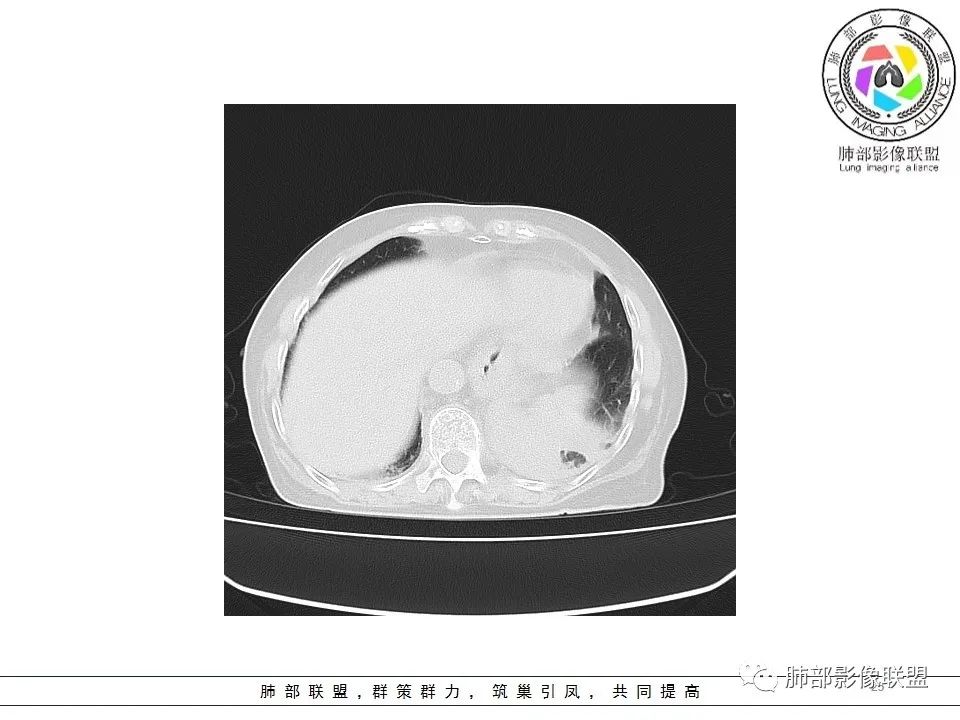 影像PPT - 【病例】最常见的纠结—老年女性,肺部大片实变影-25 影像PPT - 【病例】最常见的纠结—老年女性,肺部大片实变影-25