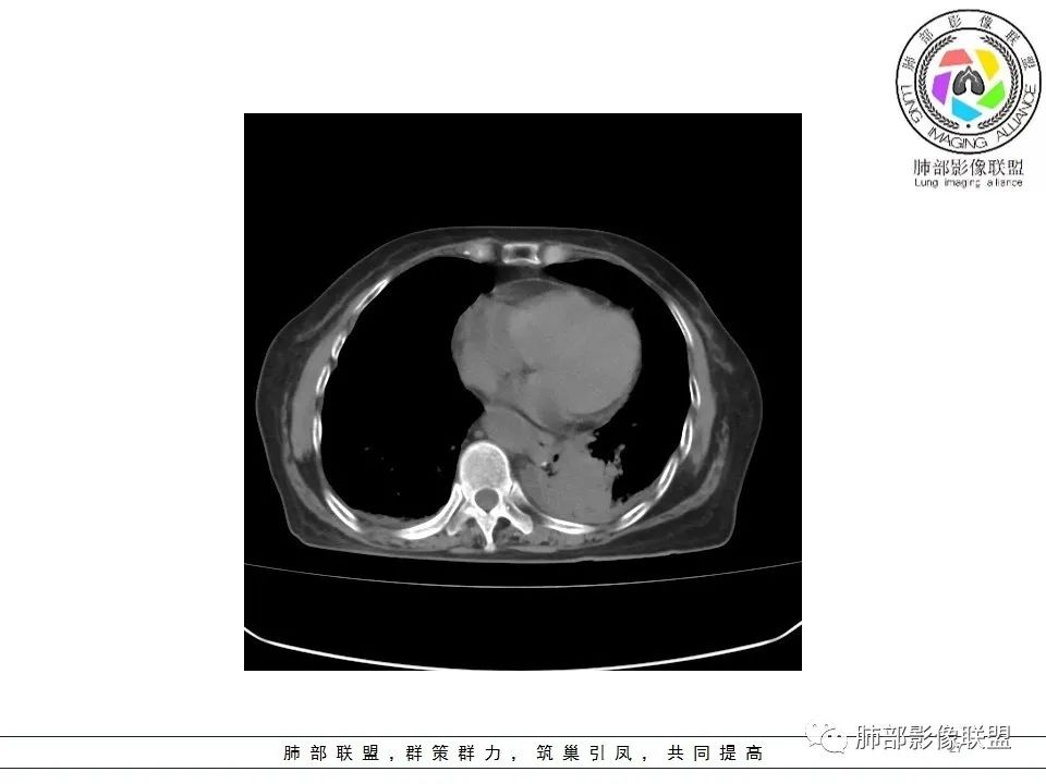 影像PPT - 【病例】最常见的纠结—老年女性,肺部大片实变影-27 影像PPT - 【病例】最常见的纠结—老年女性,肺部大片实变影-27