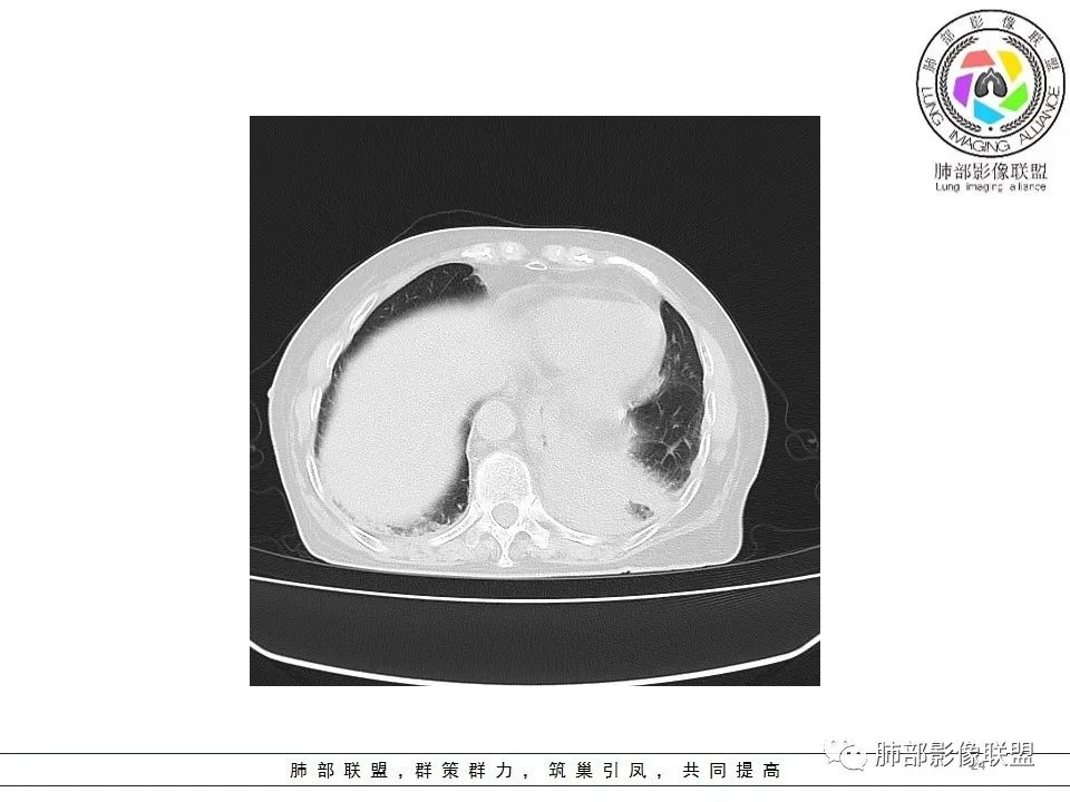 影像PPT - 【病例】最常见的纠结—老年女性,肺部大片实变影-24 影像PPT - 【病例】最常见的纠结—老年女性,肺部大片实变影-24
