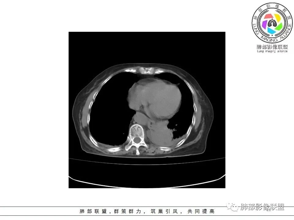 影像PPT - 【病例】最常见的纠结—老年女性,肺部大片实变影-28 影像PPT - 【病例】最常见的纠结—老年女性,肺部大片实变影-28
