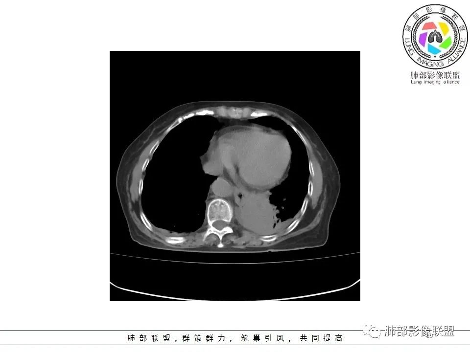 影像PPT - 【病例】最常见的纠结—老年女性,肺部大片实变影-29 影像PPT - 【病例】最常见的纠结—老年女性,肺部大片实变影-29