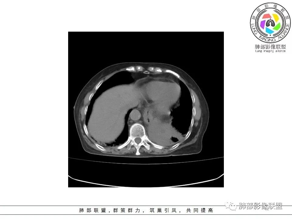 影像PPT - 【病例】最常见的纠结—老年女性,肺部大片实变影-32 影像PPT - 【病例】最常见的纠结—老年女性,肺部大片实变影-32