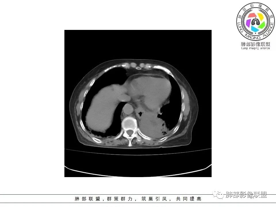影像PPT - 【病例】最常见的纠结—老年女性,肺部大片实变影-31 影像PPT - 【病例】最常见的纠结—老年女性,肺部大片实变影-31