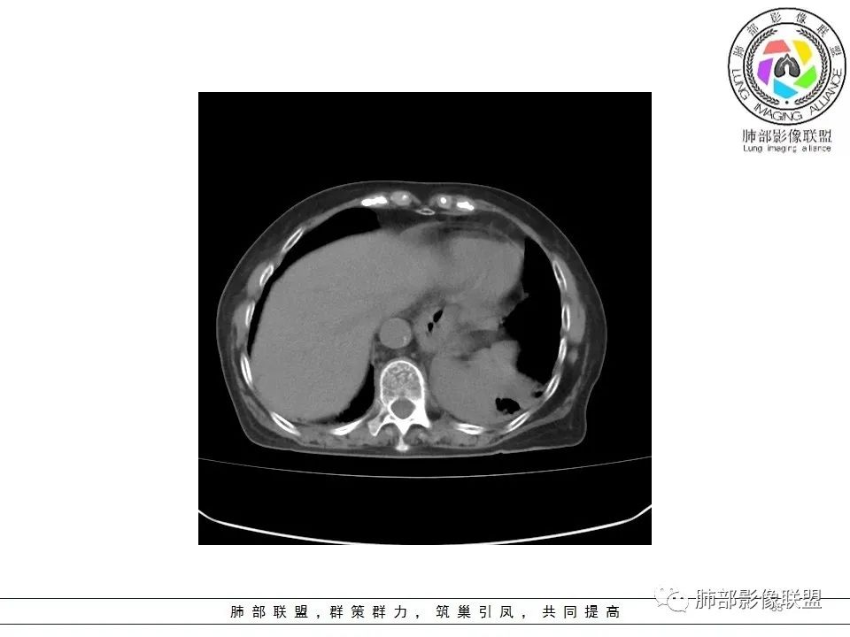 影像PPT - 【病例】最常见的纠结—老年女性,肺部大片实变影-33 影像PPT - 【病例】最常见的纠结—老年女性,肺部大片实变影-33