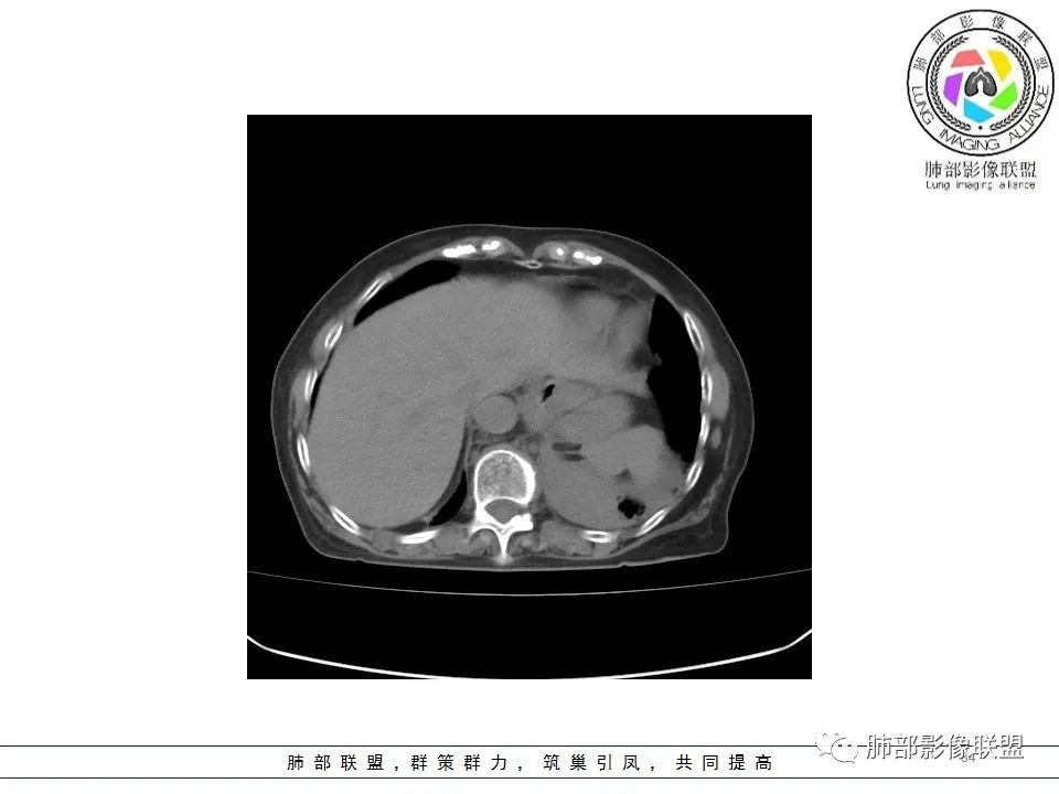 影像PPT - 【病例】最常见的纠结—老年女性,肺部大片实变影-34 影像PPT - 【病例】最常见的纠结—老年女性,肺部大片实变影-34