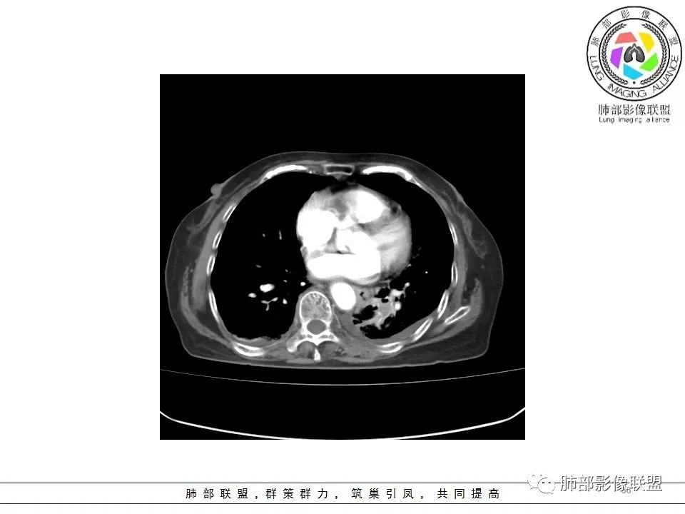 影像PPT - 【病例】最常见的纠结—老年女性,肺部大片实变影-36 影像PPT - 【病例】最常见的纠结—老年女性,肺部大片实变影-36