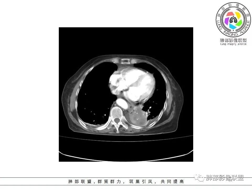 影像PPT - 【病例】最常见的纠结—老年女性,肺部大片实变影-39 影像PPT - 【病例】最常见的纠结—老年女性,肺部大片实变影-39